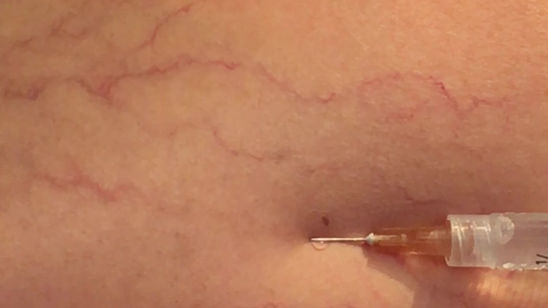 Tratamento Varicoses